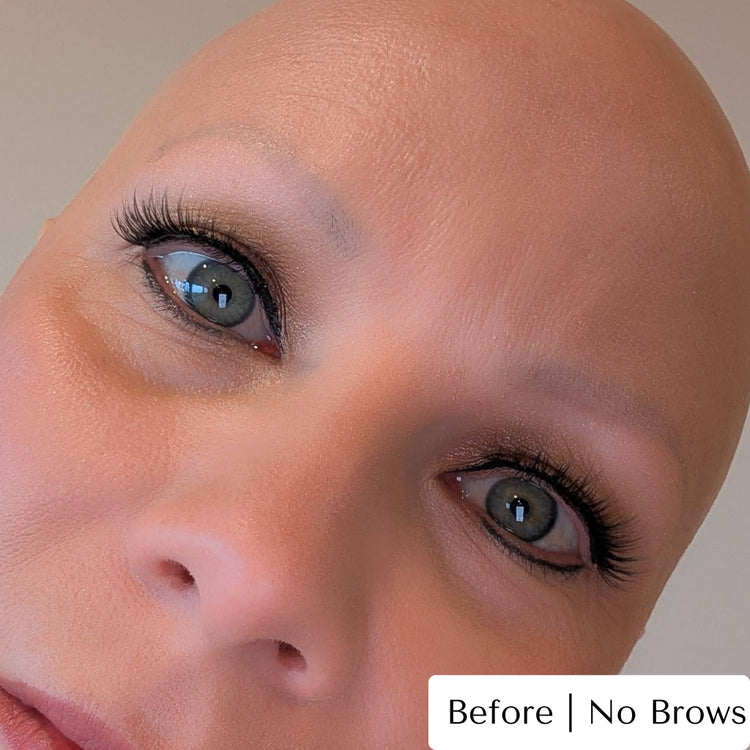 Alopecia