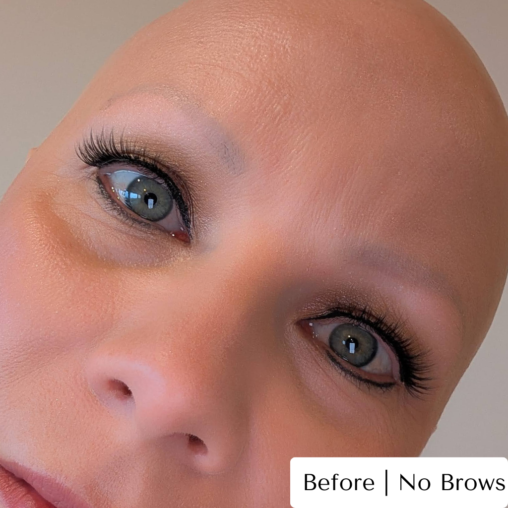 Alopecia